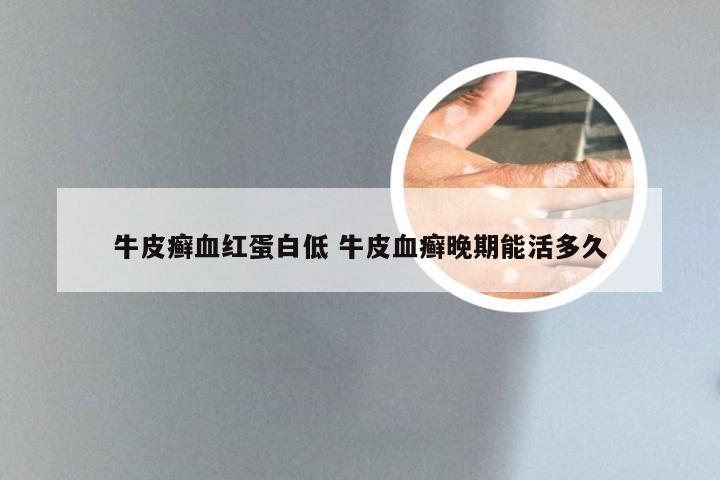 牛皮癣血红蛋白低 牛皮血癣晚期能活多久