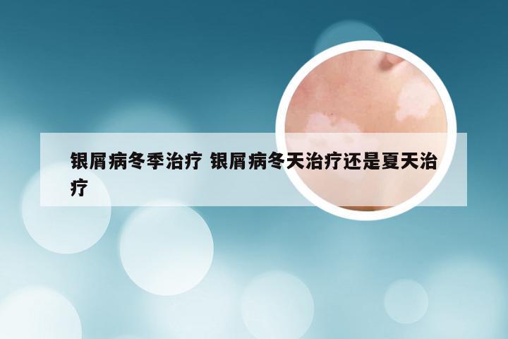 银屑病冬季治疗 银屑病冬天治疗还是夏天治疗