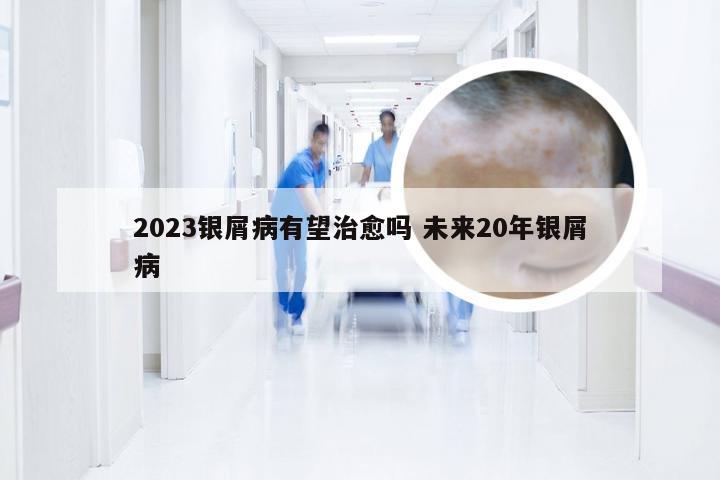2023银屑病有望治愈吗 未来20年银屑病