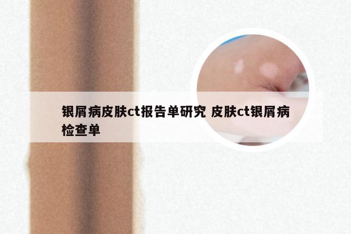 银屑病皮肤ct报告单研究 皮肤ct银屑病检查单