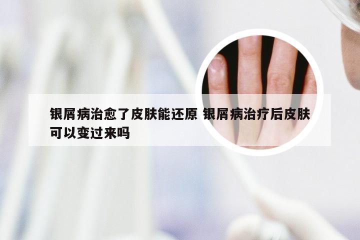 银屑病治愈了皮肤能还原 银屑病治疗后皮肤可以变过来吗