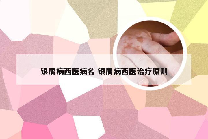 银屑病西医病名 银屑病西医治疗原则
