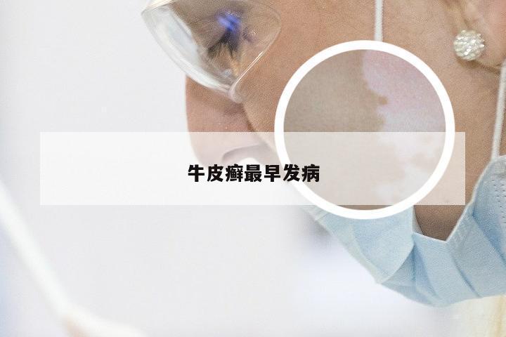 牛皮癣最早发病