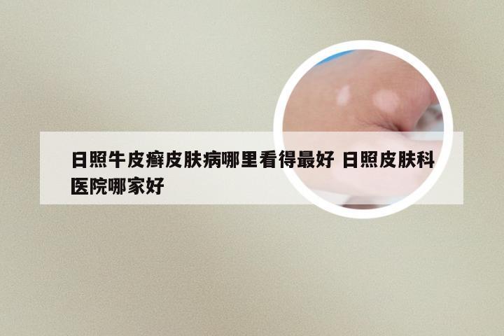 日照牛皮癣皮肤病哪里看得最好 日照皮肤科医院哪家好