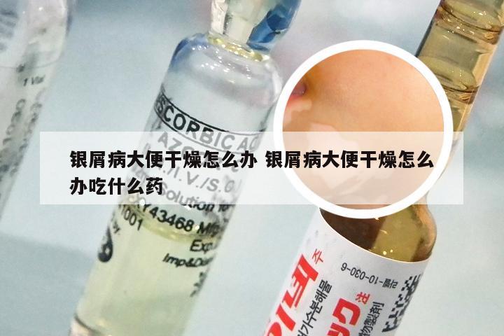 银屑病大便干燥怎么办 银屑病大便干燥怎么办吃什么药