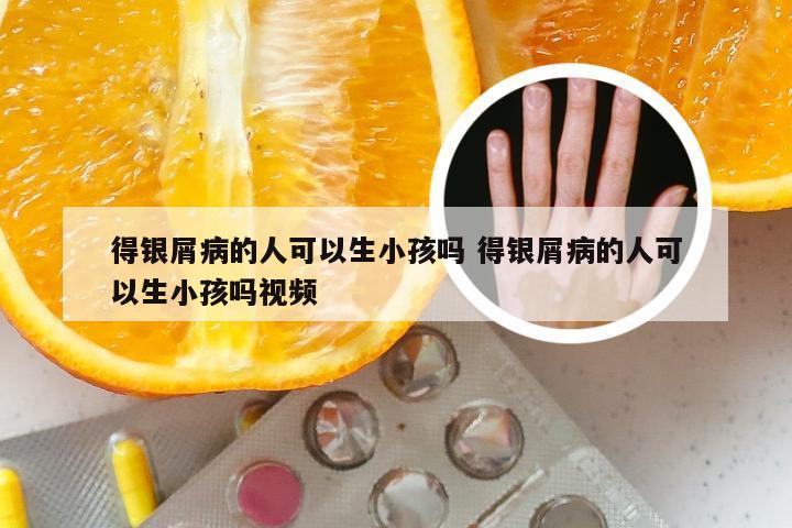 得银屑病的人可以生小孩吗 得银屑病的人可以生小孩吗视频