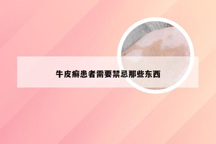 牛皮癣患者需要禁忌那些东西