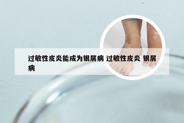 过敏性皮炎能成为银屑病 过敏性皮炎 银屑病