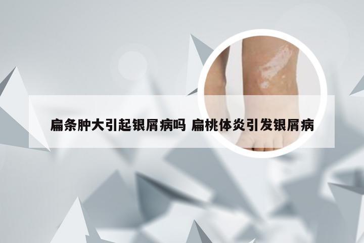 扁条肿大引起银屑病吗 扁桃体炎引发银屑病