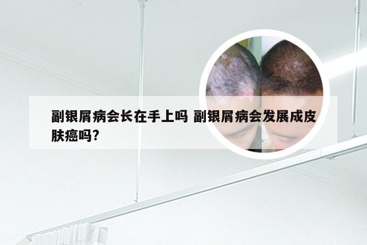 副银屑病会长在手上吗 副银屑病会发展成皮肤癌吗?