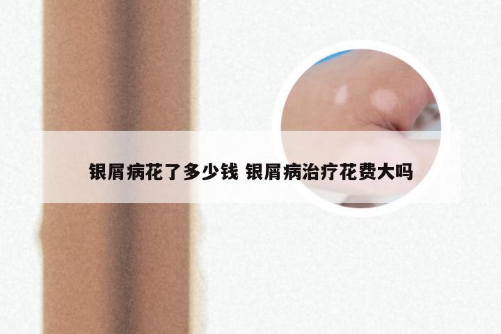 银屑病花了多少钱 银屑病治疗花费大吗