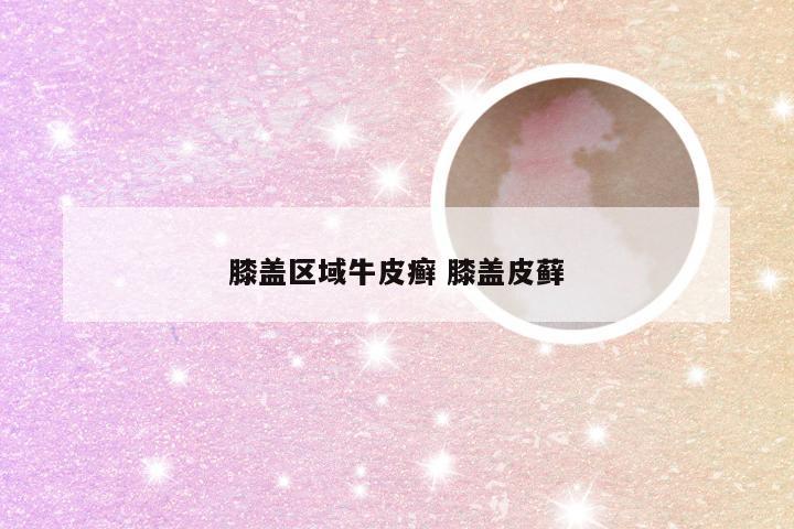 膝盖区域牛皮癣 膝盖皮藓
