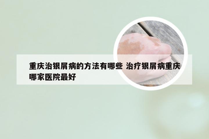 重庆治银屑病的方法有哪些 治疗银屑病重庆哪家医院最好