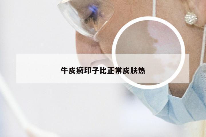 牛皮癣印子比正常皮肤热