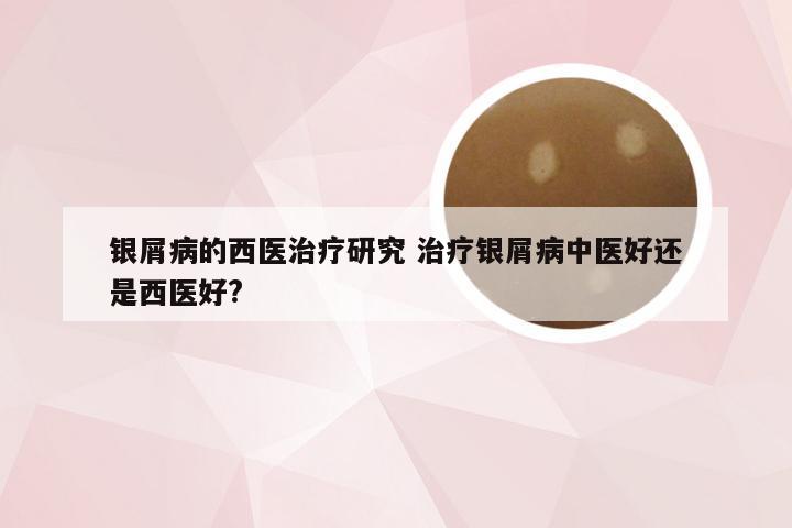 银屑病的西医治疗研究 治疗银屑病中医好还是西医好?