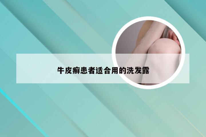 牛皮癣患者适合用的洗发露