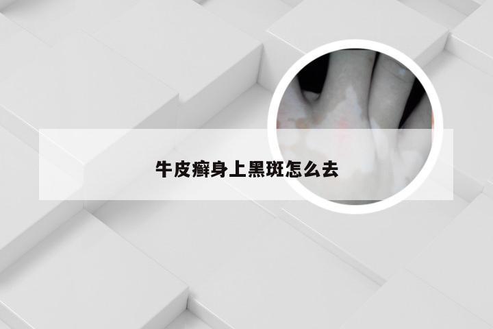 牛皮癣身上黑斑怎么去