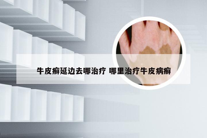 牛皮癣延边去哪治疗 哪里治疗牛皮病癣