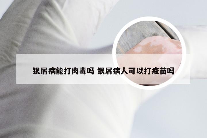 银屑病能打肉毒吗 银屑病人可以打疫苗吗