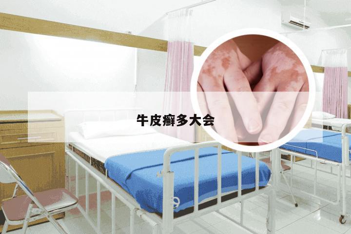 牛皮癣多大会