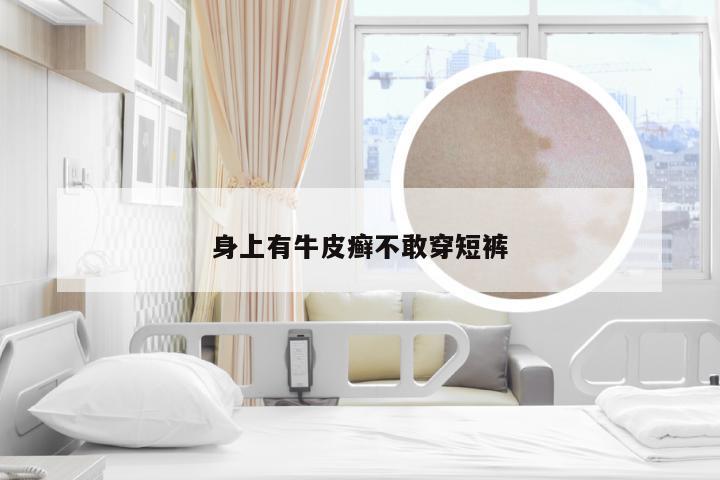 身上有牛皮癣不敢穿短裤