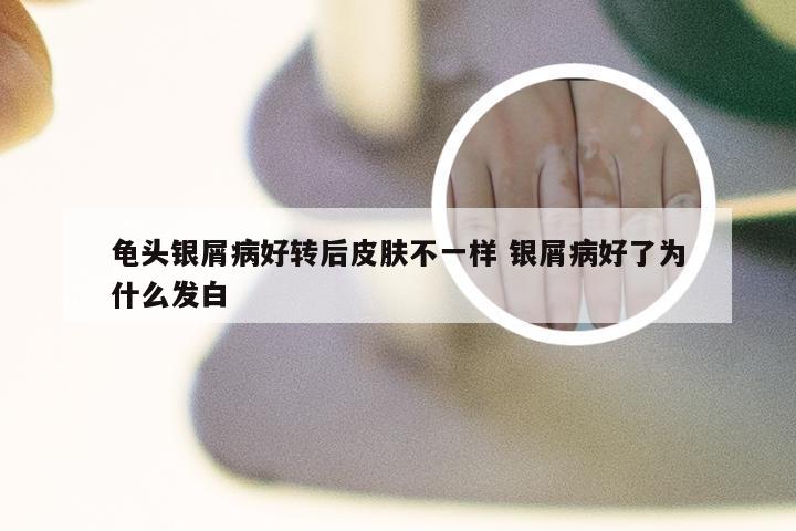 龟头银屑病好转后皮肤不一样 银屑病好了为什么发白