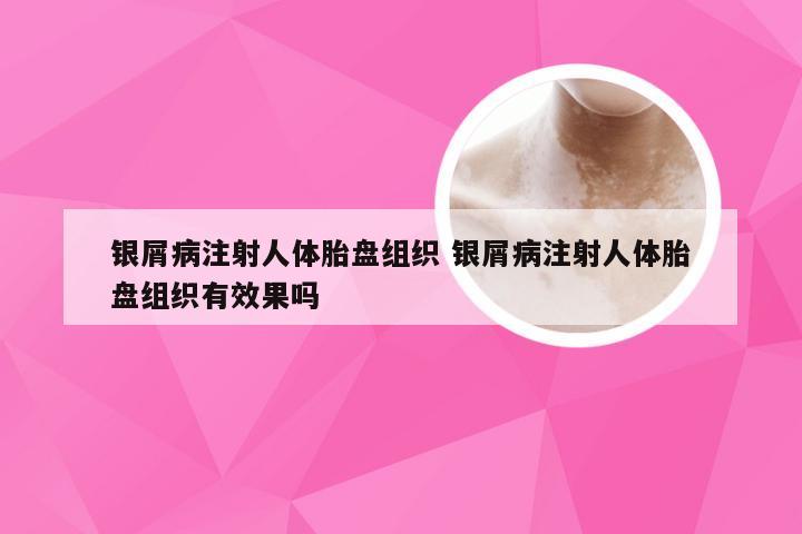 银屑病注射人体胎盘组织 银屑病注射人体胎盘组织有效果吗