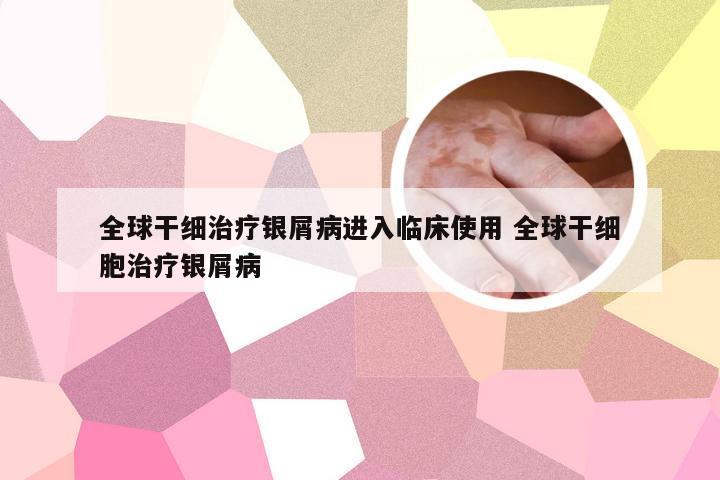 全球干细治疗银屑病进入临床使用 全球干细胞治疗银屑病