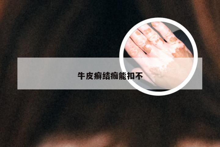 牛皮癣结痂能扣不