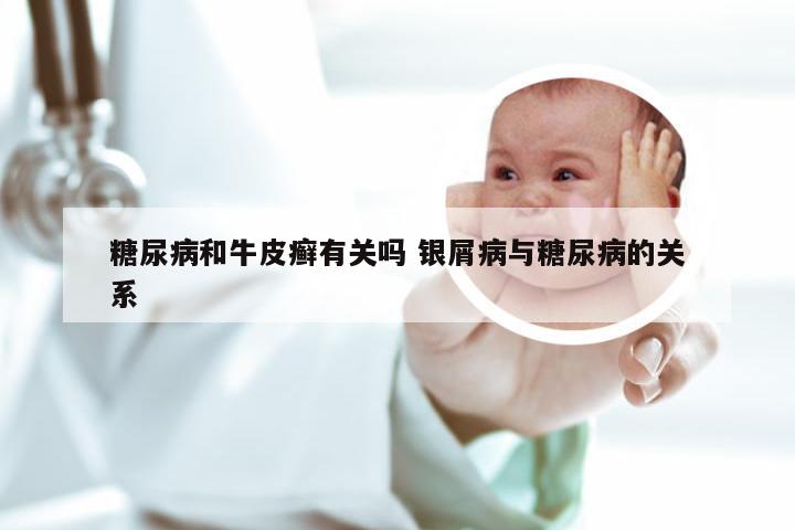 糖尿病和牛皮癣有关吗 银屑病与糖尿病的关系