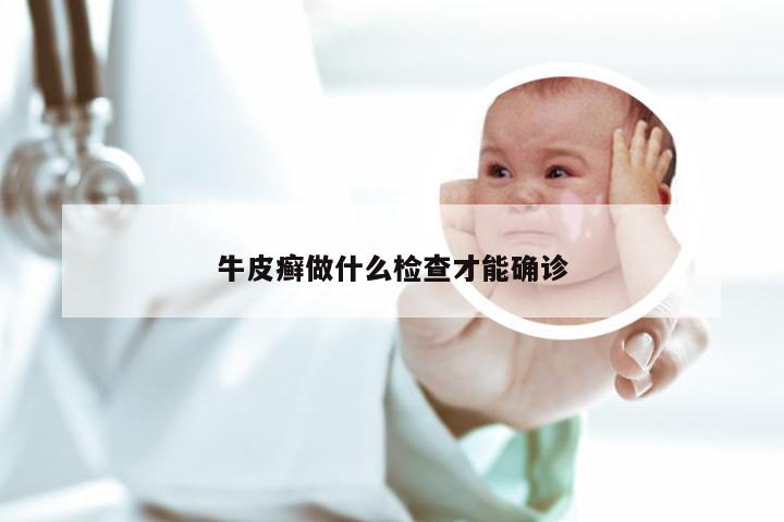 牛皮癣做什么检查才能确诊