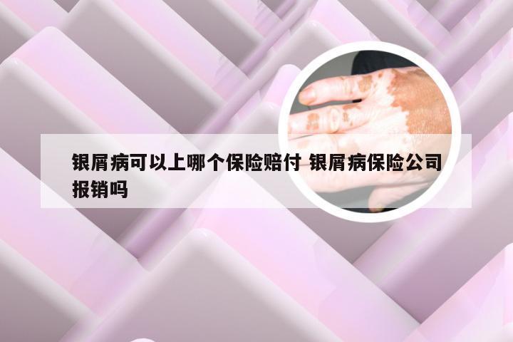 银屑病可以上哪个保险赔付 银屑病保险公司报销吗
