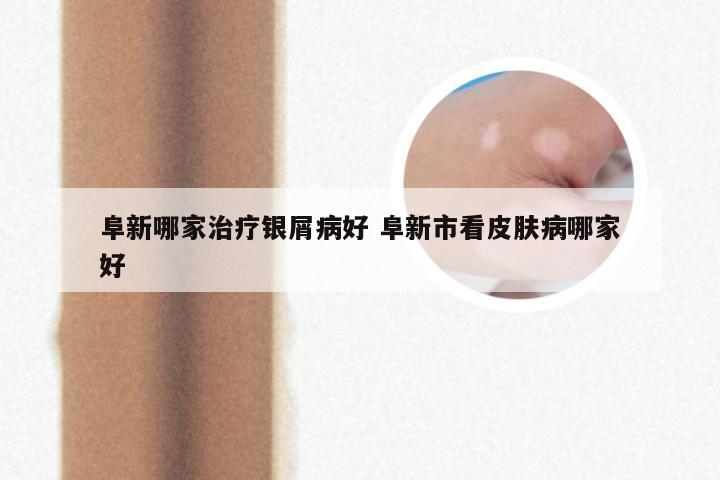 阜新哪家治疗银屑病好 阜新市看皮肤病哪家好