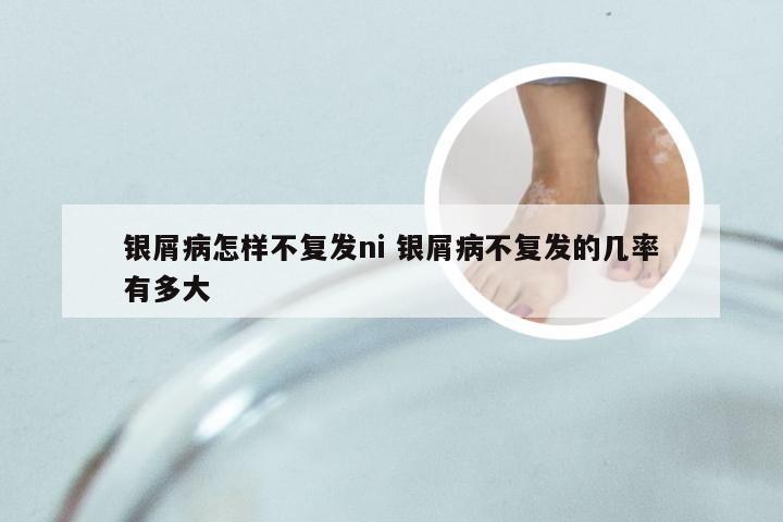 银屑病怎样不复发ni 银屑病不复发的几率有多大