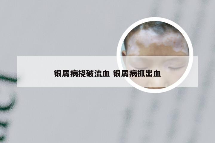 银屑病挠破流血 银屑病抓出血