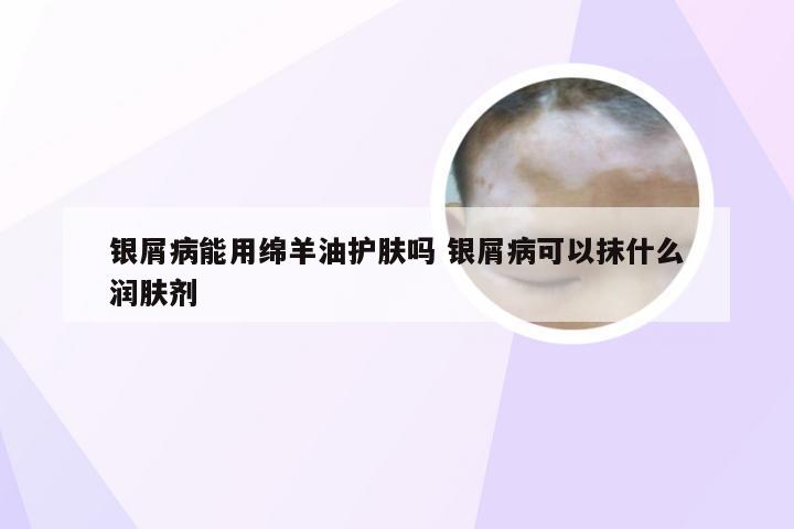 银屑病能用绵羊油护肤吗 银屑病可以抹什么润肤剂