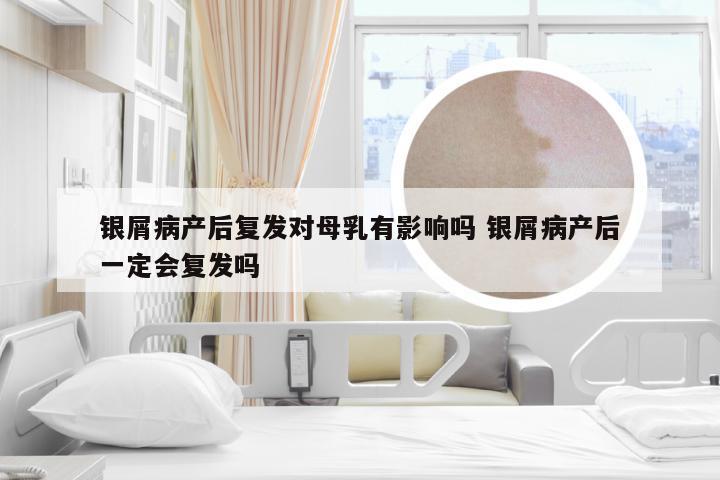 银屑病产后复发对母乳有影响吗 银屑病产后一定会复发吗