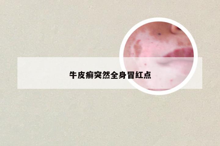 牛皮癣突然全身冒红点
