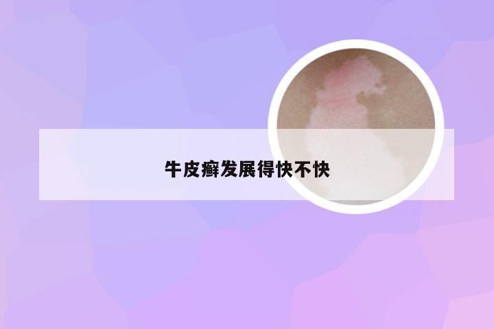 牛皮癣发展得快不快