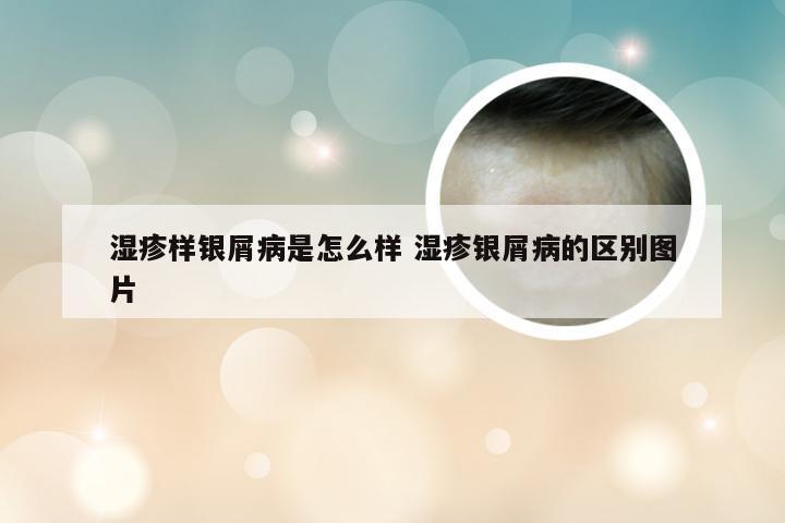 湿疹样银屑病是怎么样 湿疹银屑病的区别图片