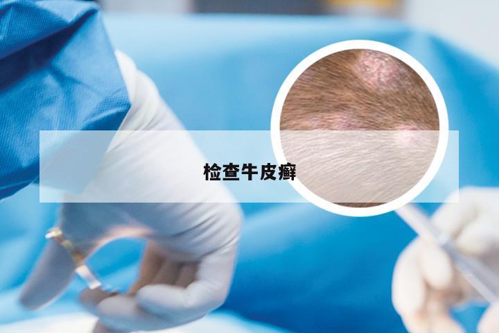 检查牛皮癣