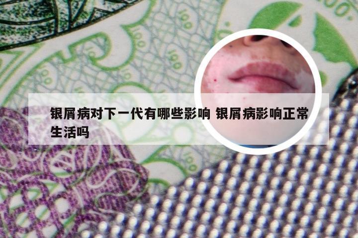 银屑病对下一代有哪些影响 银屑病影响正常生活吗