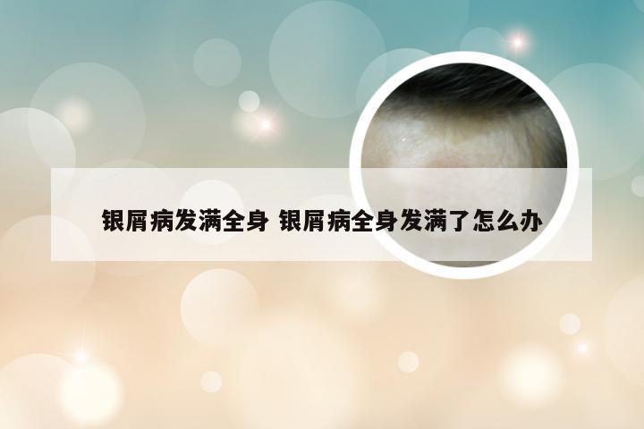 银屑病发满全身 银屑病全身发满了怎么办
