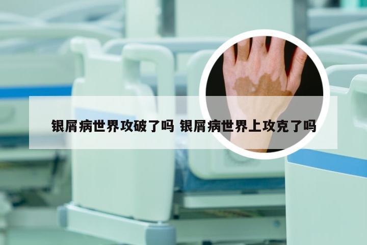 银屑病世界攻破了吗 银屑病世界上攻克了吗