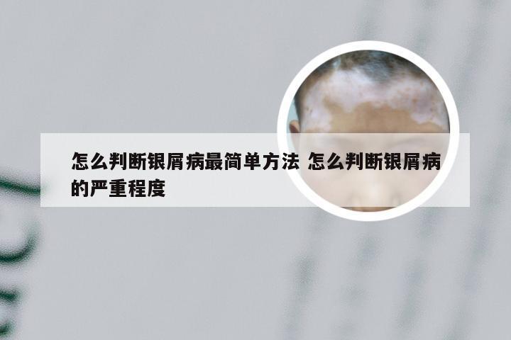 怎么判断银屑病最简单方法 怎么判断银屑病的严重程度