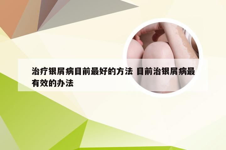 治疗银屑病目前最好的方法 目前治银屑病最有效的办法
