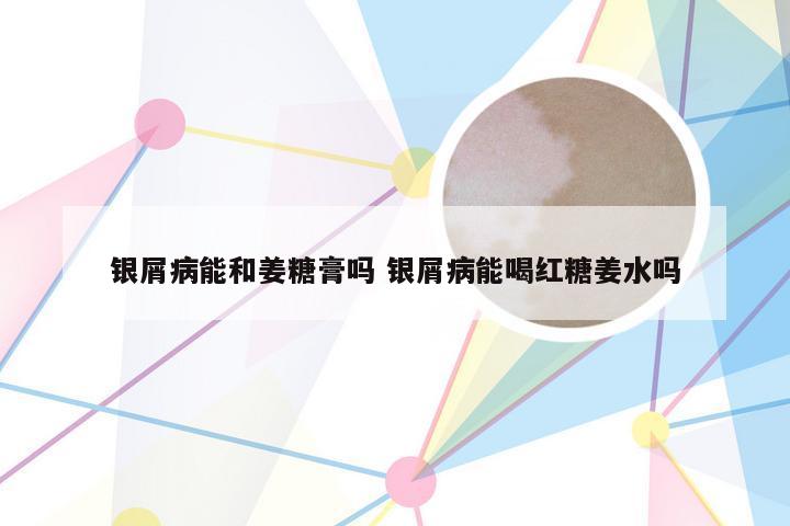 银屑病能和姜糖膏吗 银屑病能喝红糖姜水吗