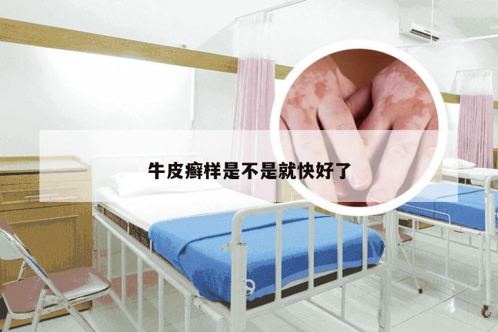 牛皮癣样是不是就快好了