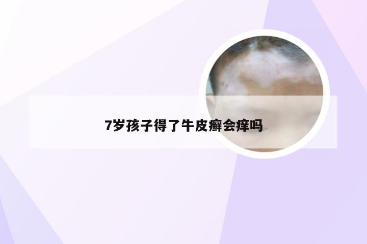 7岁孩子得了牛皮癣会痒吗