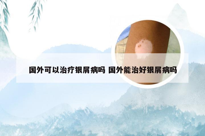 国外可以治疗银屑病吗 国外能治好银屑病吗